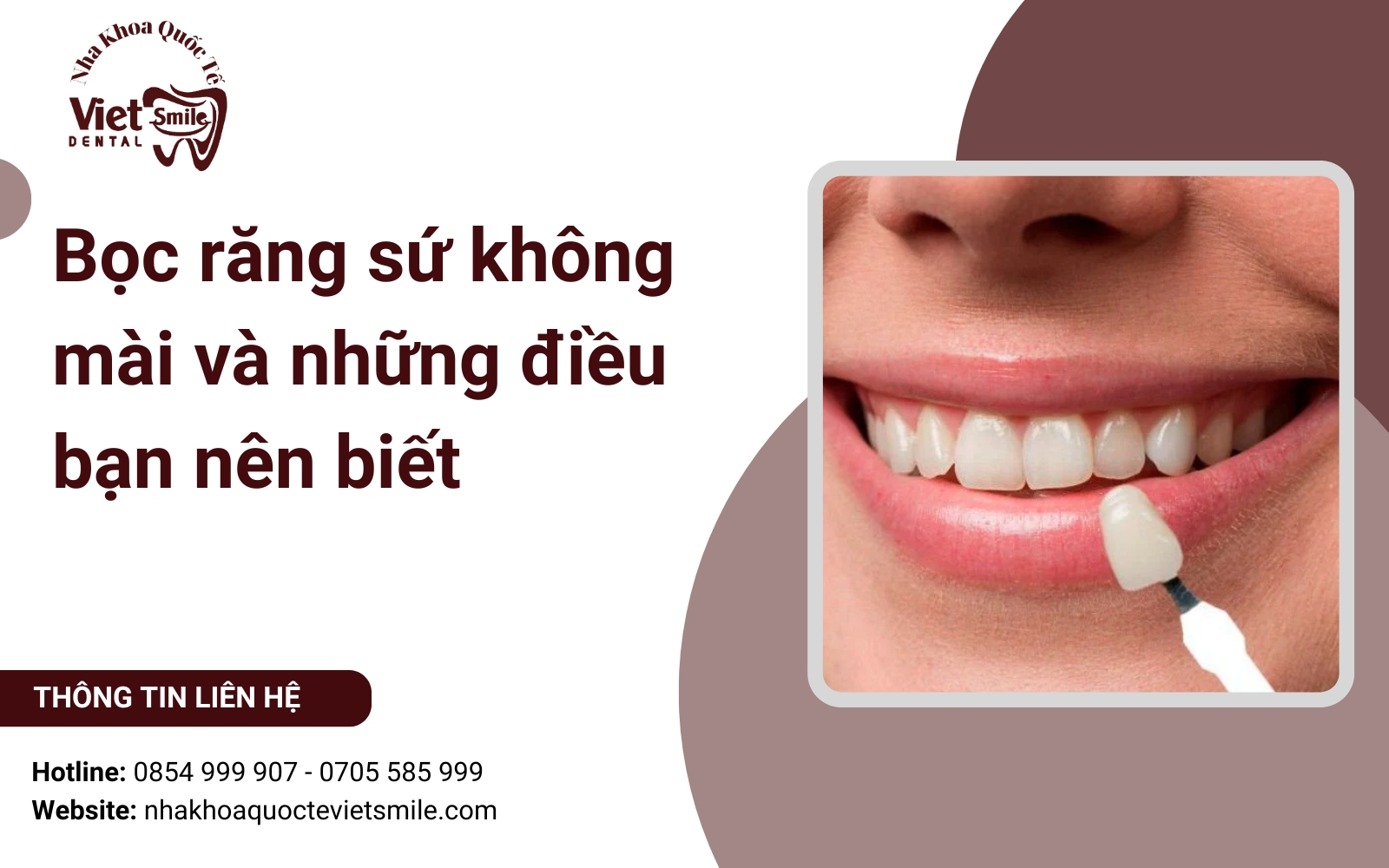 Bọc răng sứ không mài và những điều bạn nên biết