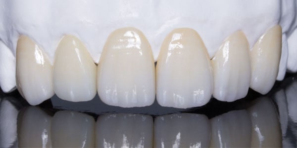 Bọc răng sứ Zirconia có tốt không?