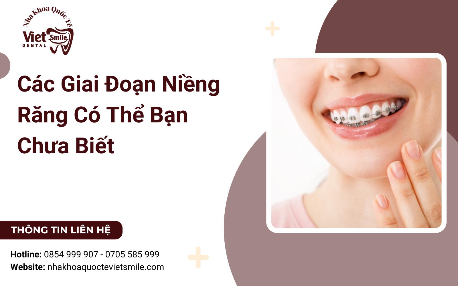 Các Giai Đoạn Niềng Răng Có Thể Bạn Chưa Biết