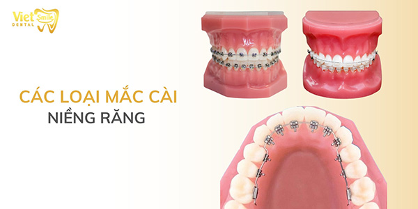 Các loại mắc cài niềng răng được nhiều người sử dụng hiện nay