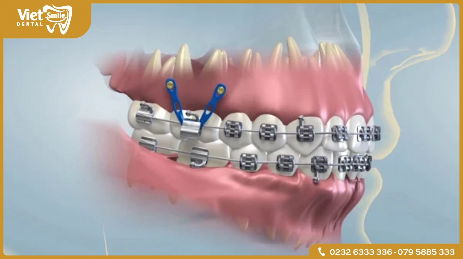 Tại sao niềng răng phải cắm vít?