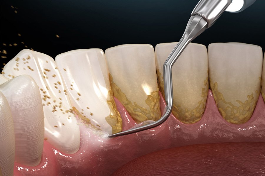 Tại sao bạn nên chọn lấy cao răng bằng sóng siêu âm