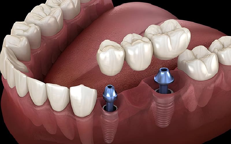 Cầu răng implant là gì?