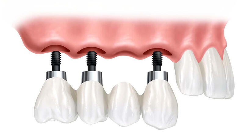 Cầu răng implant có chắc chắn không?