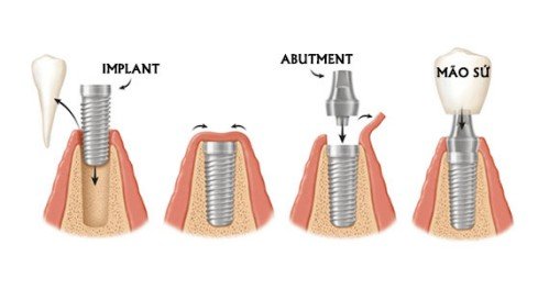 Quy trình cấy ghép implant đạt chuẩn của Bộ Y Tế