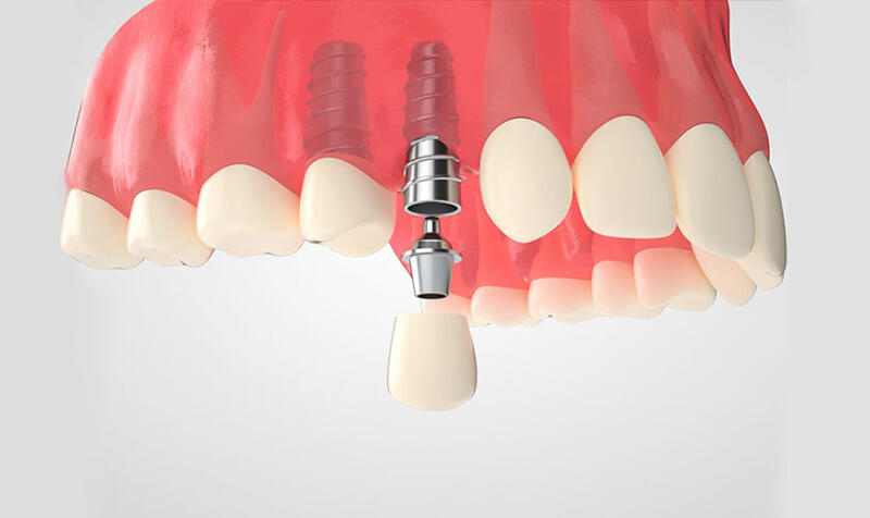 Phương pháp cấy ghép Implant