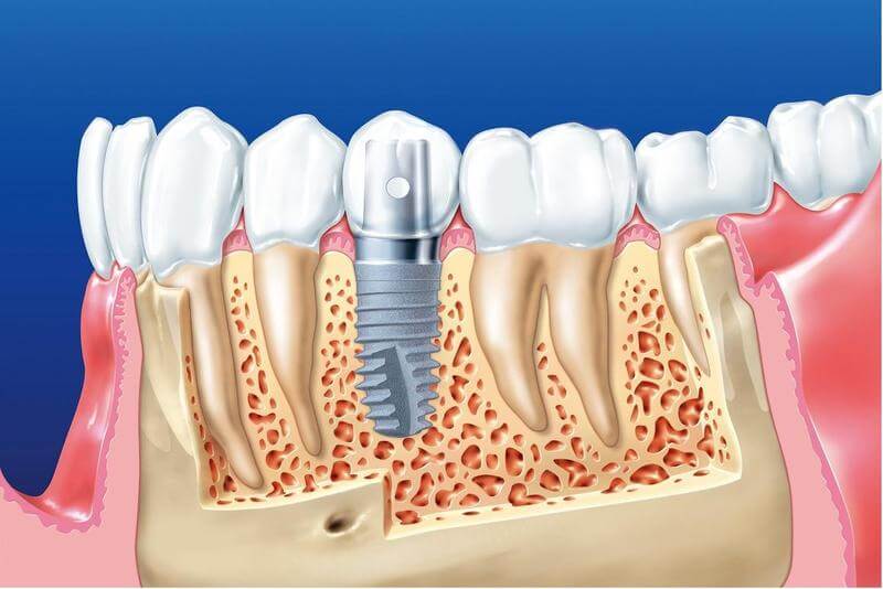 Giá trồng răng implant bao nhiêu 1 trụ?