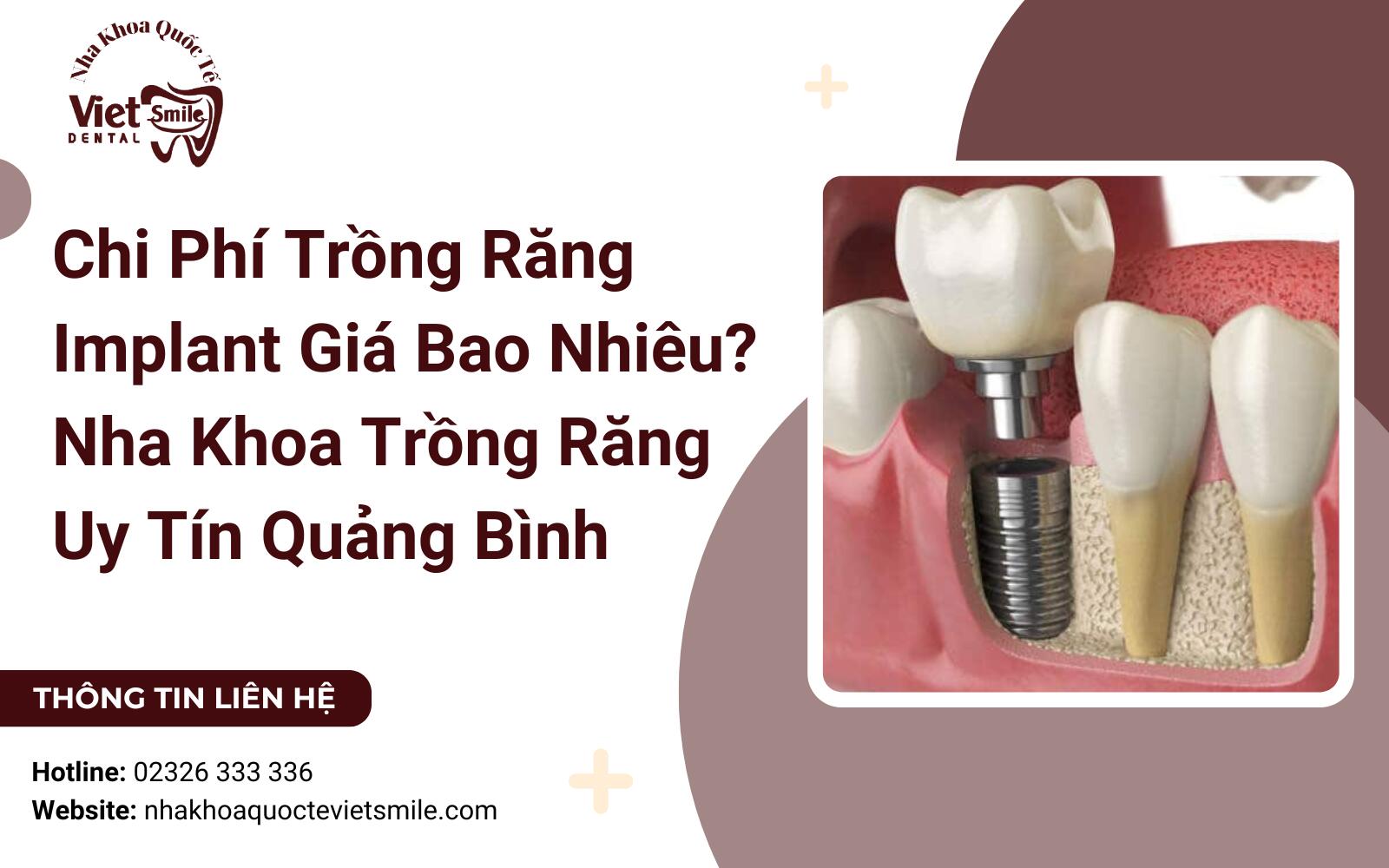 Chi Phí Trồng Răng Implant Giá Bao Nhiêu? Nha Khoa Trồng Răng Quảng Bình