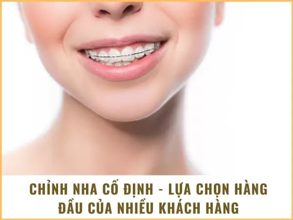 Chỉnh nha cố định là gì