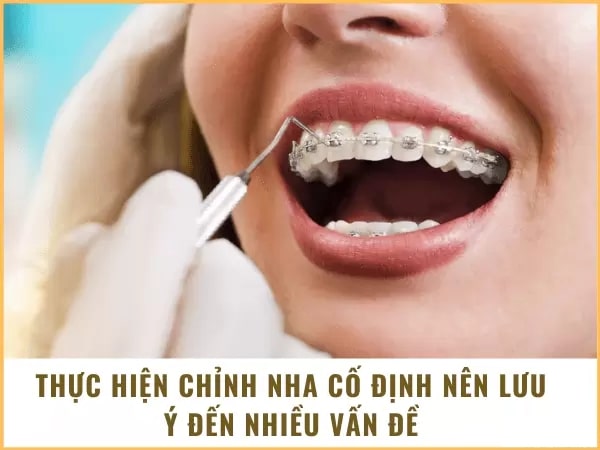 Những lưu ý khi thực hiện chỉnh nha cố định