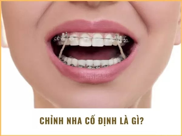 Chỉnh nha cố định - Nha khoa Quốc Tế Việt Smile