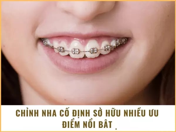 Ưu điểm của chỉnh nha cố định