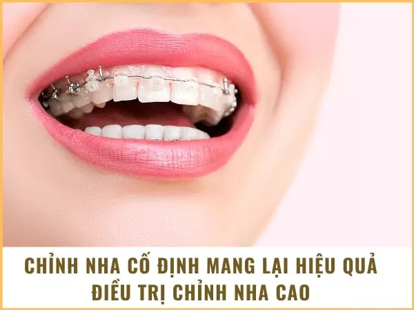 Chỉnh nha cố định hiệu quả điều trị cao