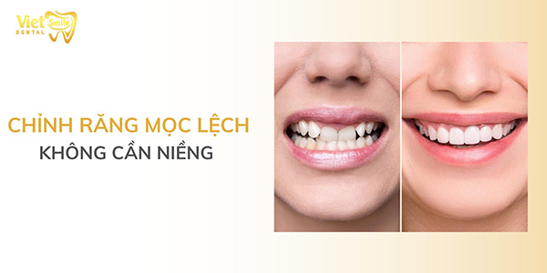 Chỉnh răng mọc lệch không cần niềng có được không?