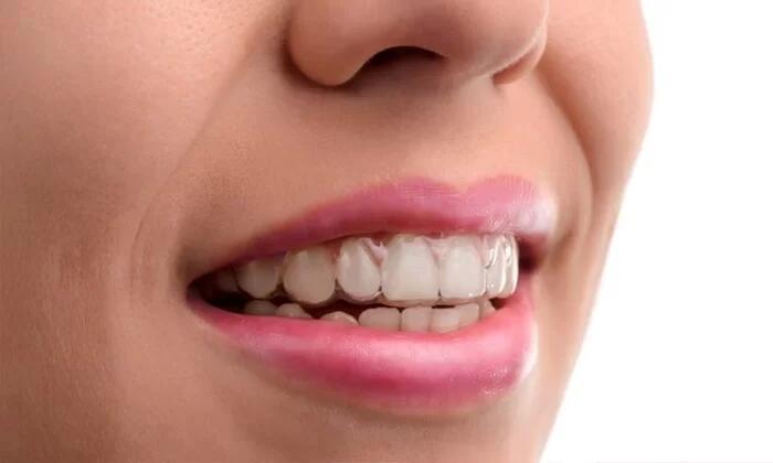 Niềng răng trong suốt Invisalign