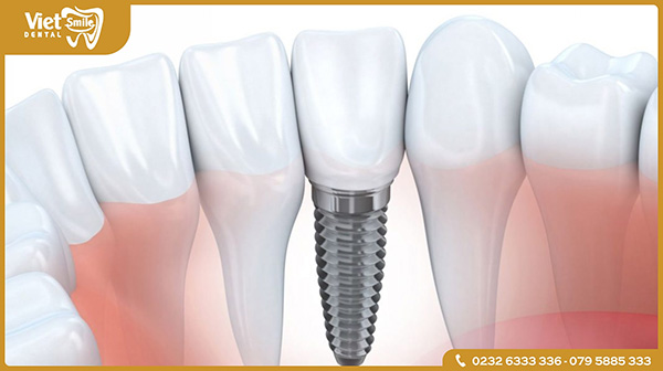 Trồng răng Implant là gì?