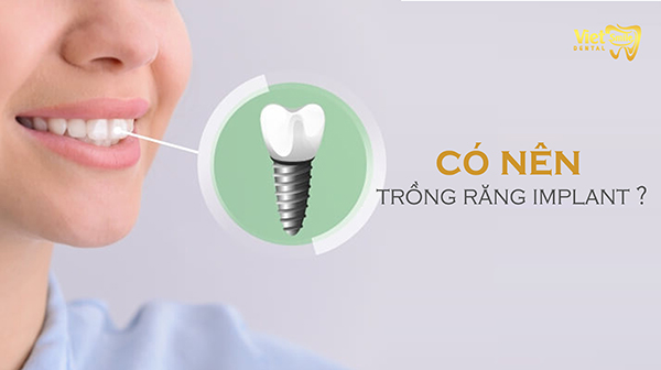 có nên trồng răng implant