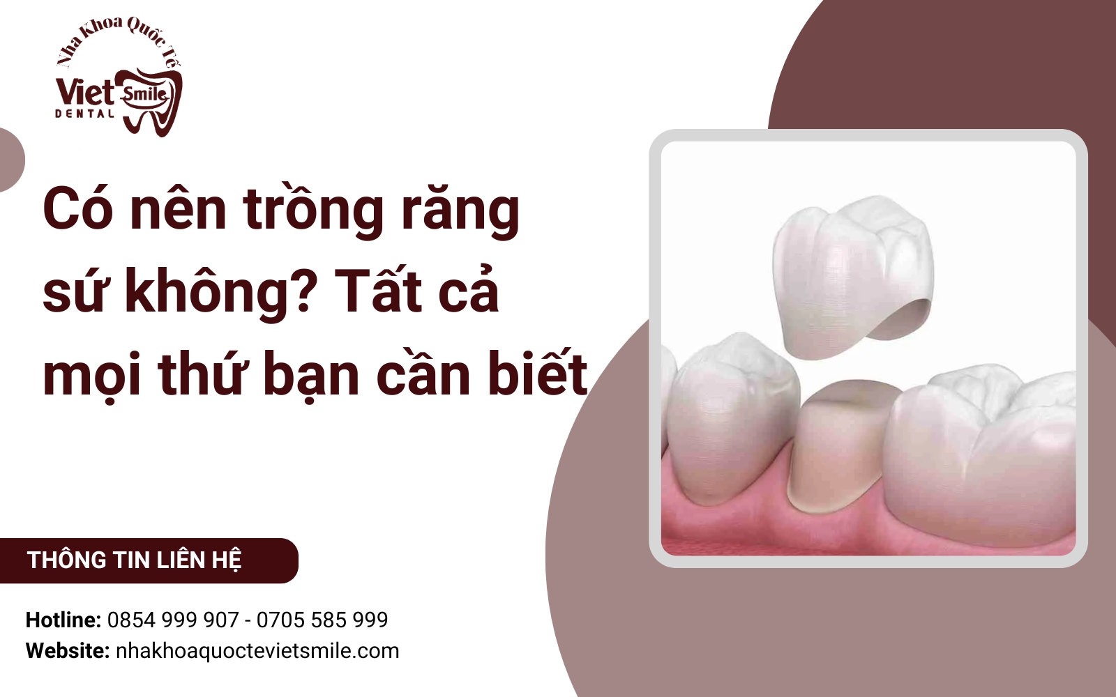 Có nên trồng răng sứ không? Tất cả mọi thứ bạn cần biết