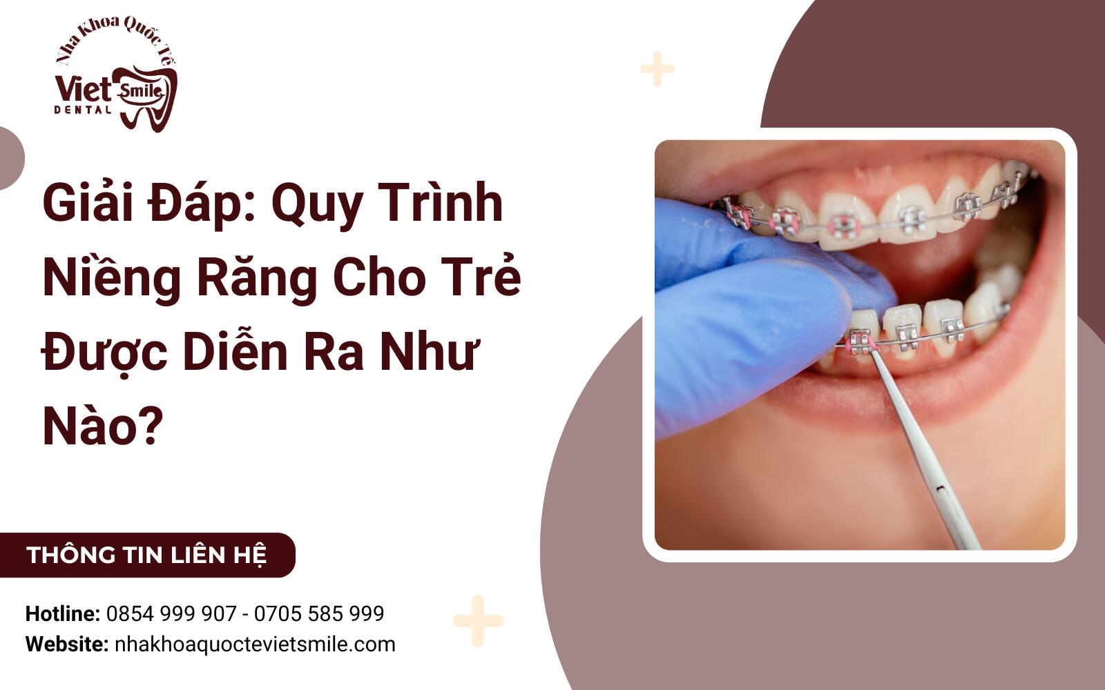 Giải Đáp: Quy Trình Niềng Răng Cho Trẻ Được Diễn Ra Như Nào?