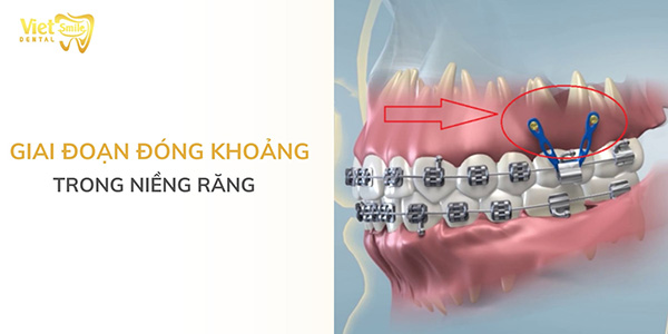 Giai đoạn đóng khoảng trong niềng răng mất bao lâu?