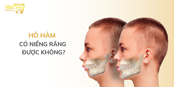 Hô hàm có niềng răng được không? Giải pháp nào tốt?