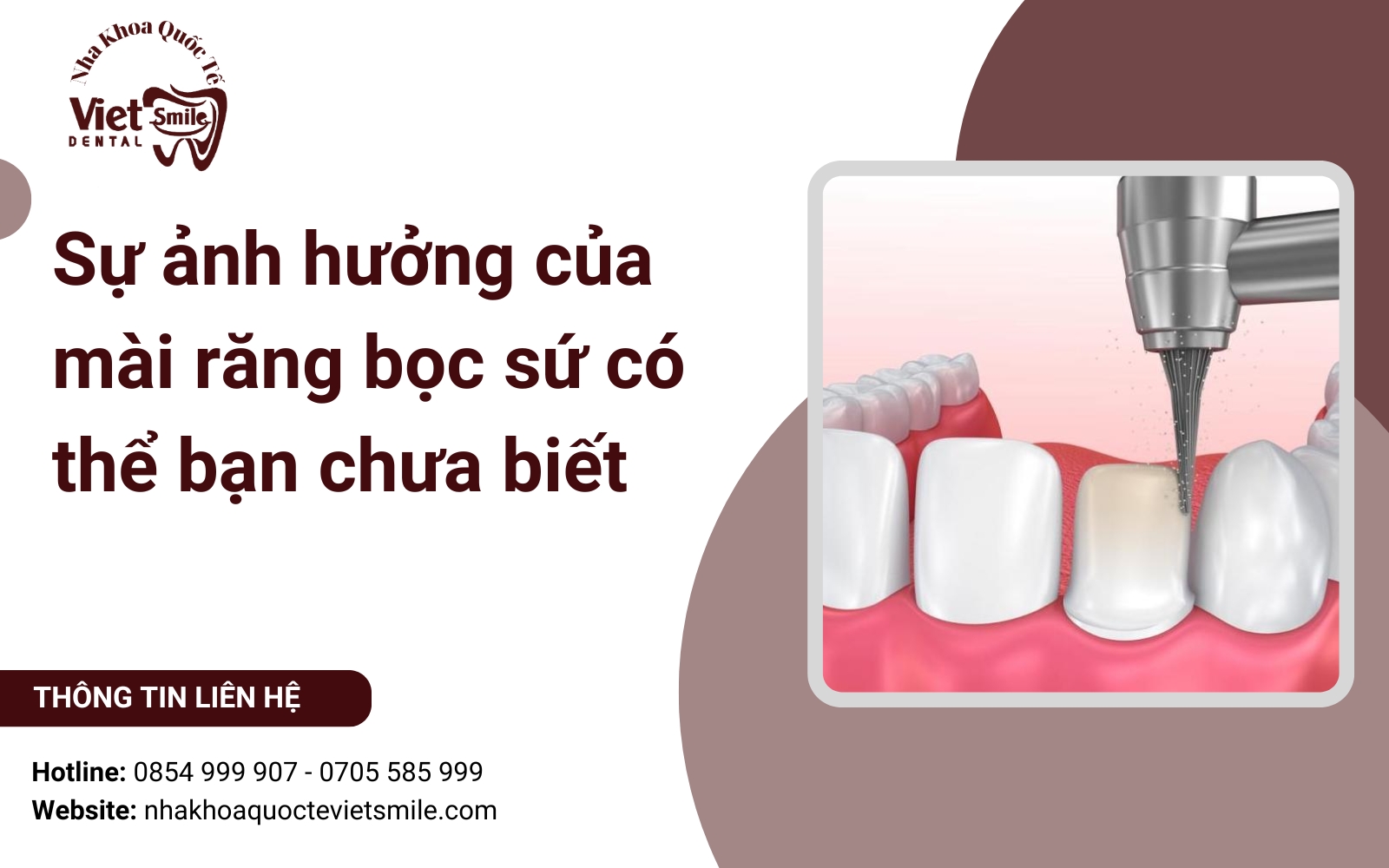 Sự ảnh hưởng của mài răng bọc sứ có thể bạn chưa biết