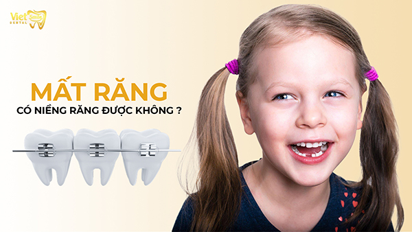 Mất răng có niềng răng được không? Hậu quả khi mất răng