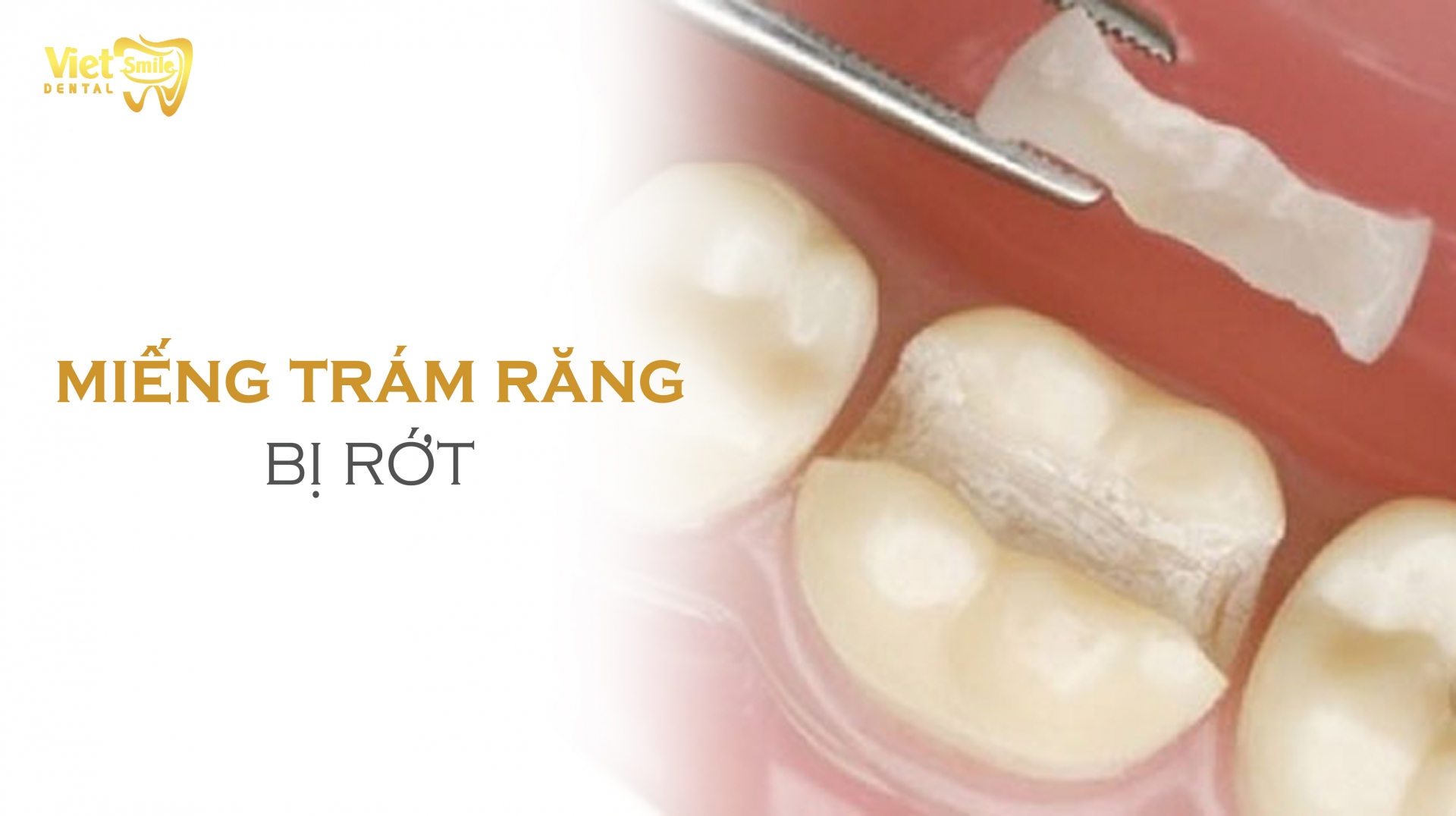 Miếng Trám Răng Bị Rớt: Nguyên Nhân, Cách Xử Lý và Phòng Ngừa Hiệu Quả