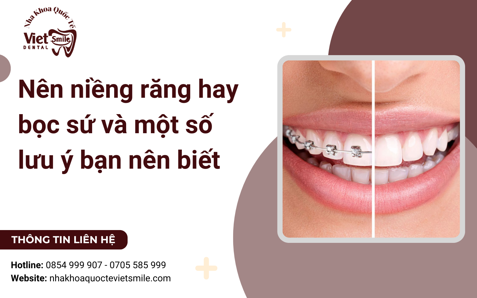 Nên niềng răng hay bọc sứ và một số lưu ý bạn nên biết