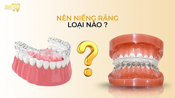 Nên niềng răng loại nào? Ưu/ Nhược điểm của từng loại