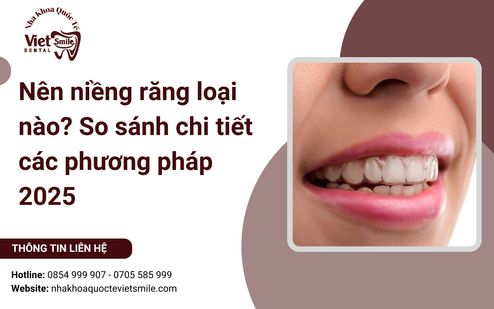 Nên niềng răng loại nào? So sánh chi tiết các phương pháp 2025