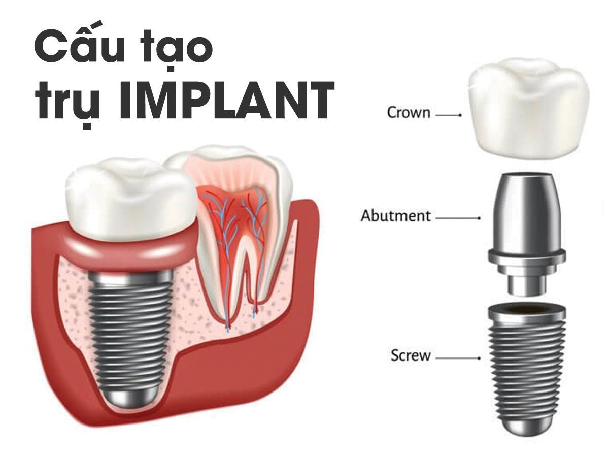 Implant là gì ? Chúng có cấu tạo như thế nào?