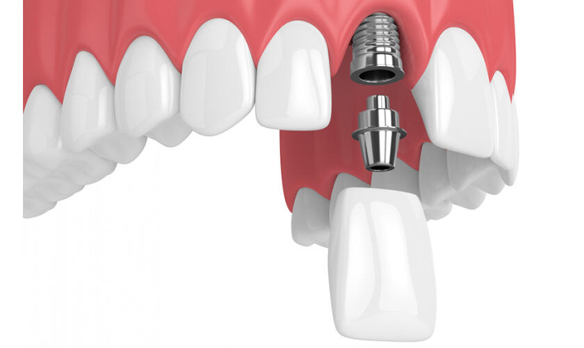 Khi mất răng cửa, lựa chọn trụ Implant nào là tốt nhất?