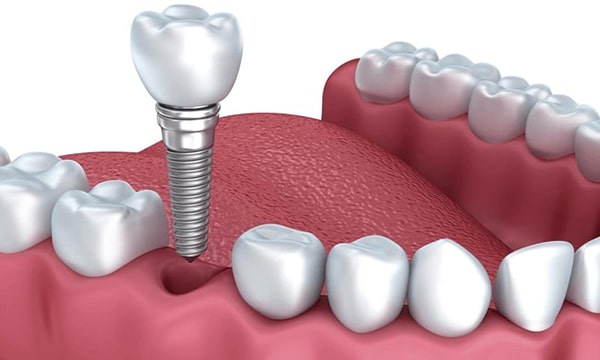 Cấy ghép Implant là gì?