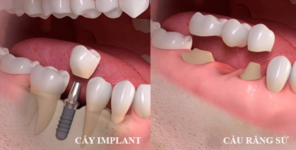 So sánh cầu răng sứ và Implant