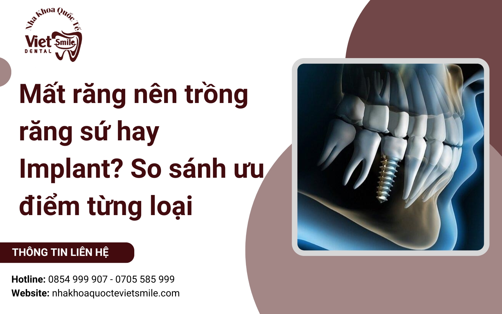 Mất răng nên trồng răng sứ hay Implant? So sánh ưu điểm từng loại