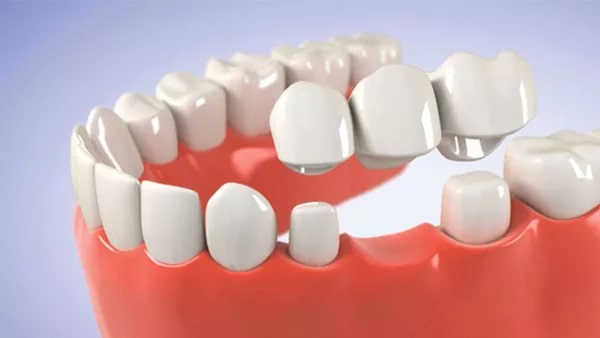 Trồng răng sứ được những ưu, nhược điểm gì?