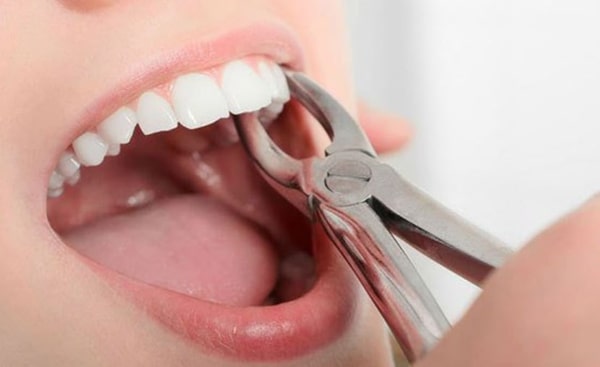 Nhổ răng vĩnh viễn có ảnh hưởng gì không?