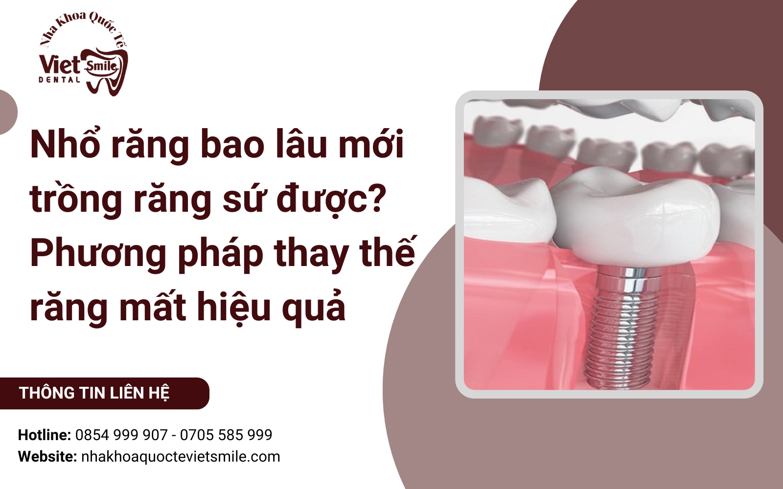 Nhổ răng bao lâu mới trồng răng sứ được? Phương pháp thay thế răng mất hiệu quả