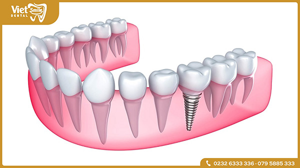 Trồng răng Implant là gì?