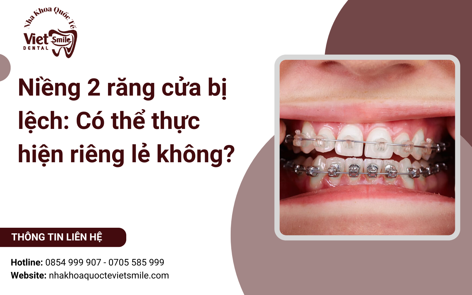 Niềng 2 răng cửa bị lệch: Có thể thực hiện riêng lẻ không?