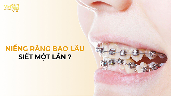 Niềng răng bao lâu siết một lần? Bí quyết giảm đau khi siết răng 