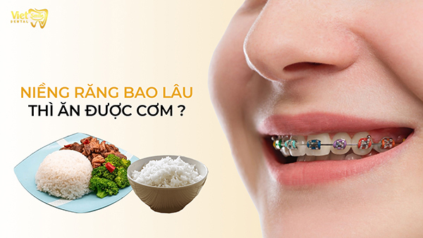 Niềng răng bao lâu thì ăn được cơm như bình thường?