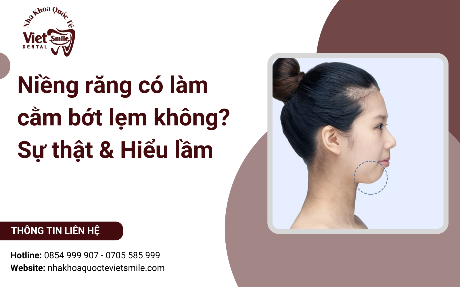 Niềng răng có làm cằm bớt lẹm không? Sự thật & Hiểu lầm
