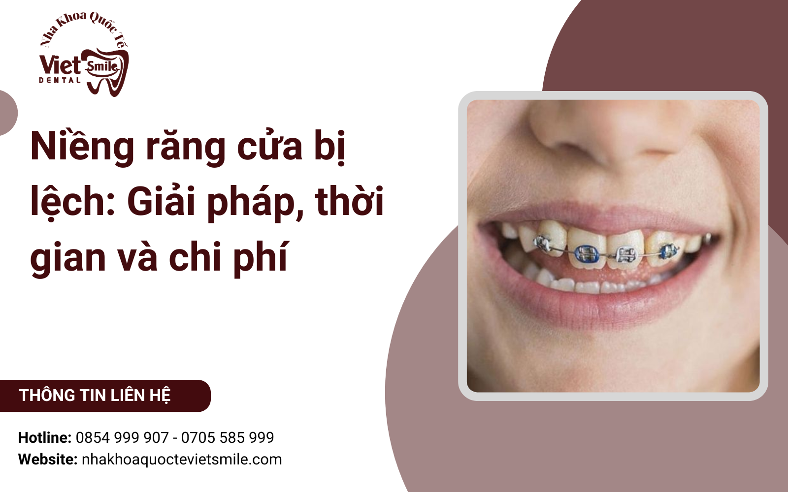 Niềng răng cửa bị lệch: Giải pháp, thời gian và chi phí