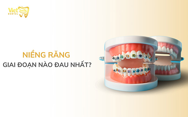 Niềng răng giai đoạn nào đau nhất? Cơn đau của mỗi giai đoạn