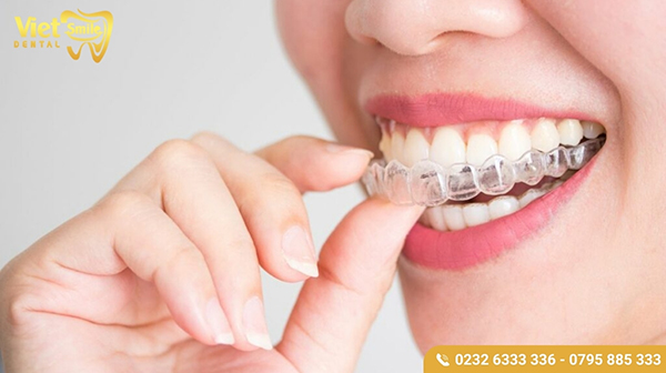 Niềng răng không mắc cài invisalign là gì?