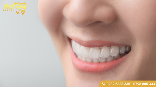 Ưu,nhược điểm của niềng răng trong suốt invisalign