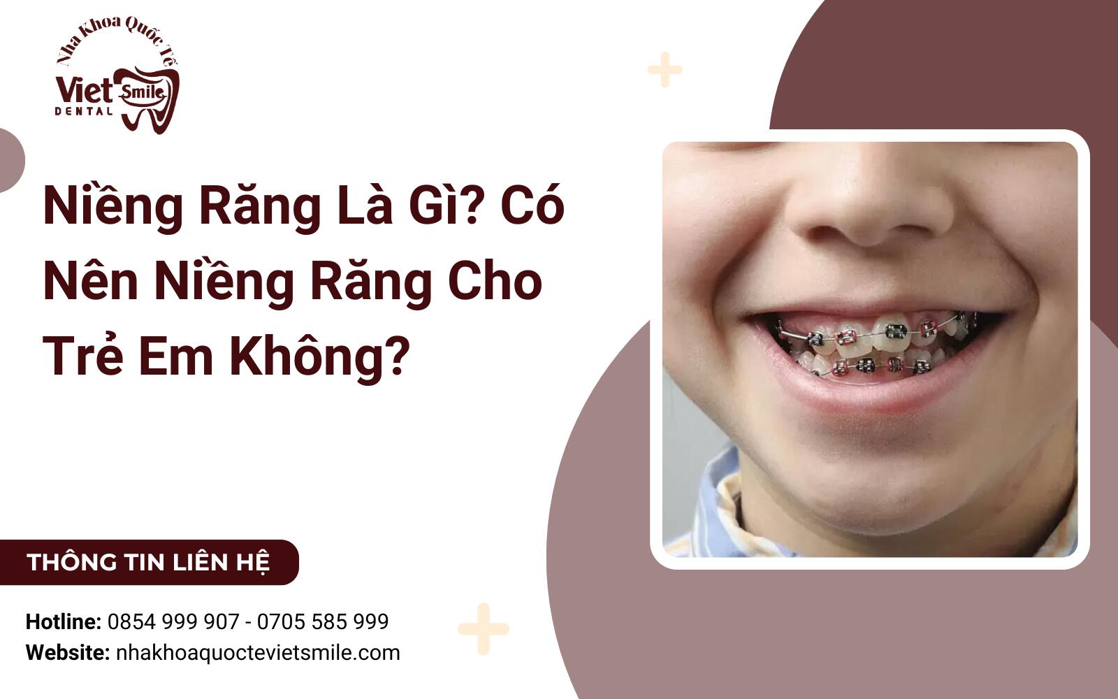 Niềng Răng Là Gì? Có Nên Niềng Răng Cho Trẻ Em Không?