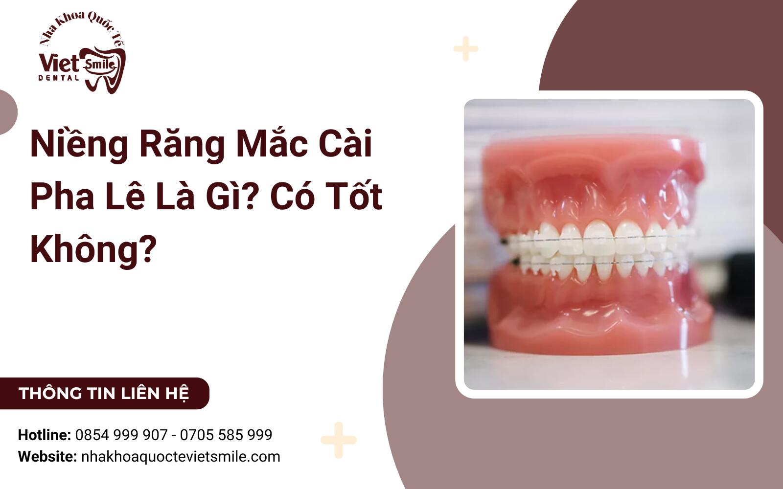 Niềng Răng Mắc Cài Pha Lê Là Gì? Có Tốt Không?